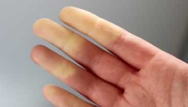 fenomeen van raynaud